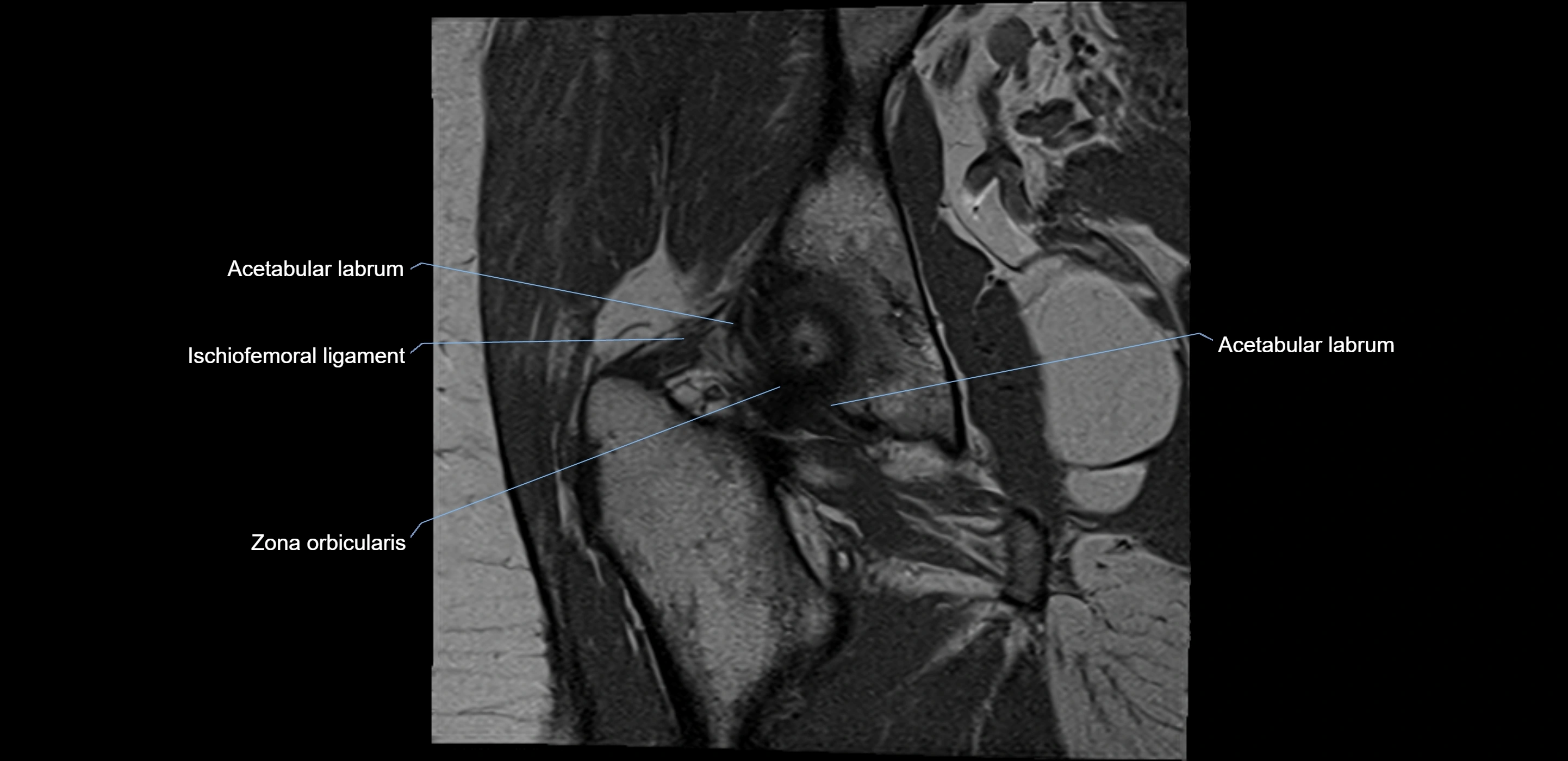 MRI Hip ligaments coronal cross sectional anatomy 3T  radiology  image-img-00001-00018.webp